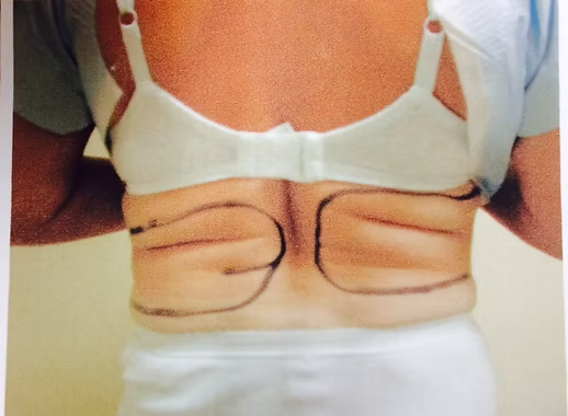 liposuction1