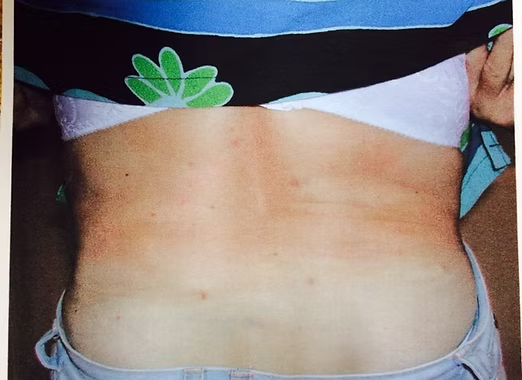liposuction1a