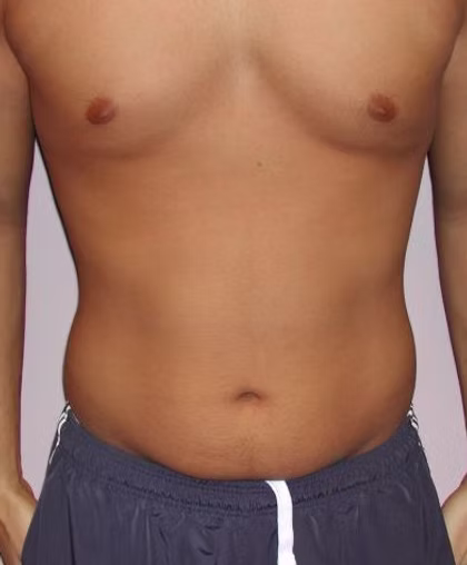 liposuction3
